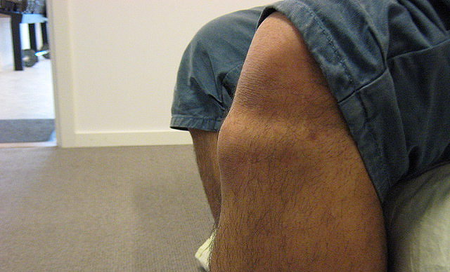 Osgood Schlatter knæ